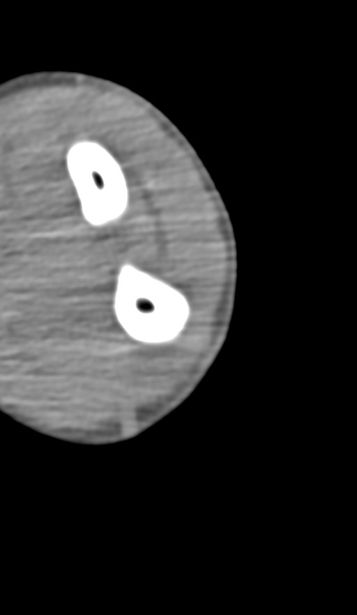 Chronic osteomyelitis of the distal humerus (Radiopaedia 78351-90971 Axial non-contrast 128).jpg