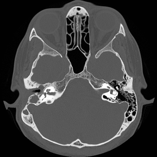 File:Chronic otomastoiditis (Radiopaedia 27138-27309 Axial bone window 1).jpg