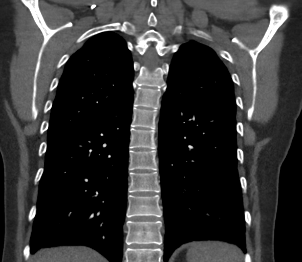 Chronic pulmonary embolus (Radiopaedia 39129-41341 Coronal C+ CTPA 63).png
