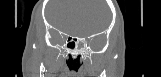 Chronic sphenoidal sinusitis (Radiopaedia 62030-70122 Coronal bone window 107).jpg