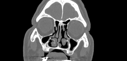 Chronic sphenoidal sinusitis (Radiopaedia 62030-70122 Coronal bone window 39).jpg