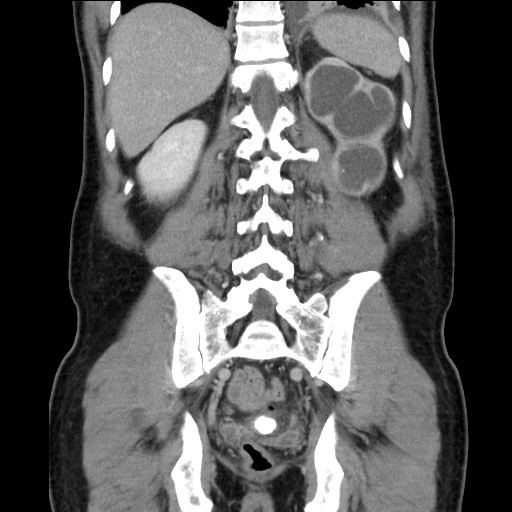 Chronic ureteropelvic junction obstruction (Radiopaedia 78365-90996 B 76).jpg