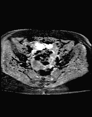 File:Class II Mullerian duct anomaly- unicornuate uterus with rudimentary horn and non-communicating cavity (Radiopaedia 39441-41755 Axial ADC 13).jpg