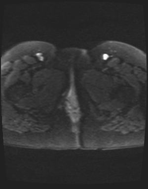Class II Mullerian duct anomaly- unicornuate uterus with rudimentary horn and non-communicating cavity (Radiopaedia 39441-41755 Axial DWI 30).jpg