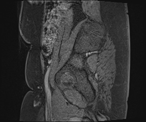 Class II Mullerian duct anomaly- unicornuate uterus with rudimentary horn and non-communicating cavity (Radiopaedia 39441-41755 G 118).jpg