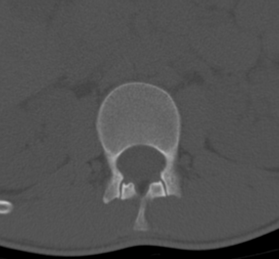Clear cell meningoma - lumbar spine (Radiopaedia 60116-67691 Axial bone window 12).png