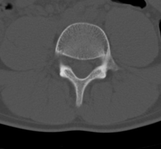 Clear cell meningoma - lumbar spine (Radiopaedia 60116-67691 Axial bone window 51).png