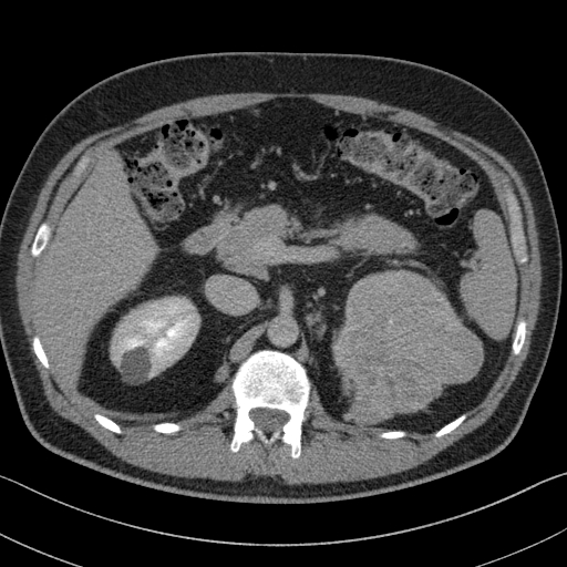 File:Clear cell renal cell carcinoma (Radiopaedia 61449-69393 H 20).jpg