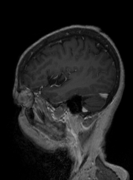 File:Clival meningioma (Radiopaedia 53278-59248 Sagittal T1 C+ 336).jpg
