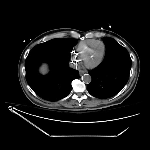 Closed loop obstruction due to adhesive band, resulting in small bowel ischemia and resection (Radiopaedia 83835-99023 Axial non-contrast 14).jpg