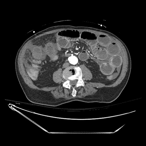 Closed loop obstruction due to adhesive band, resulting in small bowel ischemia and resection (Radiopaedia 83835-99023 B 84).jpg