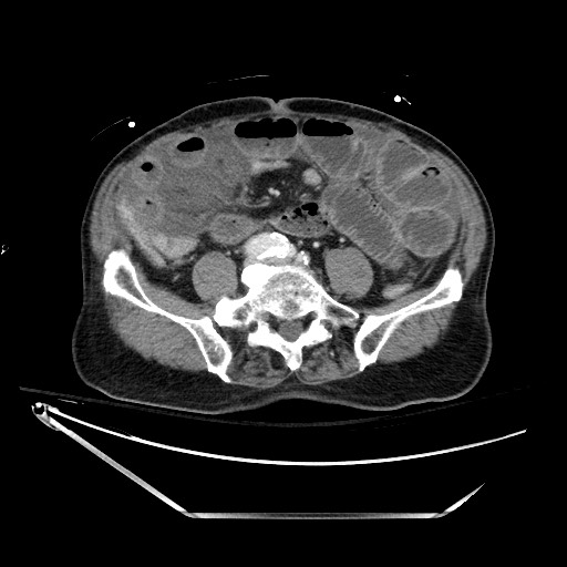 File:Closed loop obstruction due to adhesive band, resulting in small bowel ischemia and resection (Radiopaedia 83835-99023 D 101).jpg