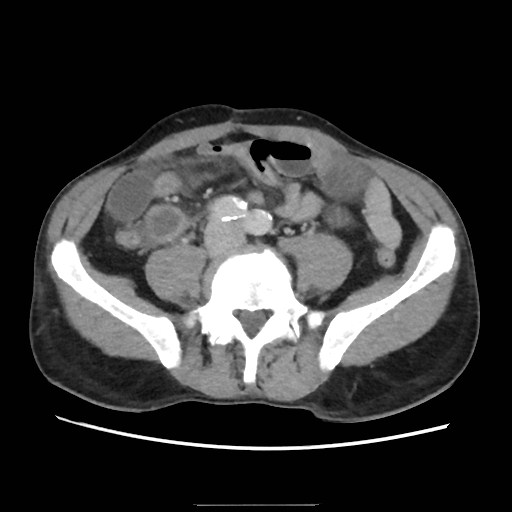 File:Closed loop small bowel obstruction (Radiopaedia 59227-66554 A 57).jpg