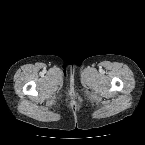 File:Closed loop small bowel obstruction (Radiopaedia 65403-74451 A 90).jpg