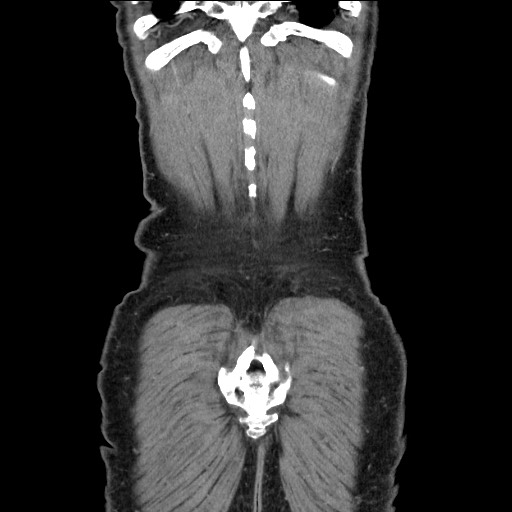 Closed loop small bowel obstruction - omental adhesion causing "internal hernia" (Radiopaedia 85129-100682 B 118).jpg