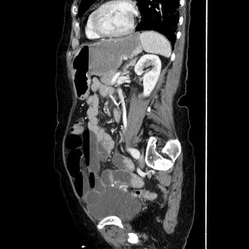 Closed loop small bowel obstruction due to adhesive band, with intramural hemorrhage and ischemia (Radiopaedia 83831-99017 D 124).jpg