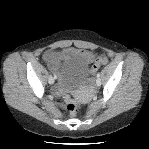 File:Closed loop small bowel obstruction due to trans-omental herniation (Radiopaedia 35593-37109 A 72).jpg