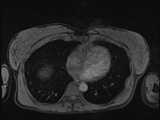 Closed loop small bowel obstruction in pregnancy (MRI) (Radiopaedia 87637-104031 Axial T1 fat sat 4).jpg