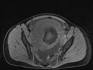 Closed loop small bowel obstruction in pregnancy (MRI) (Radiopaedia 87637-104031 F 50).jpg