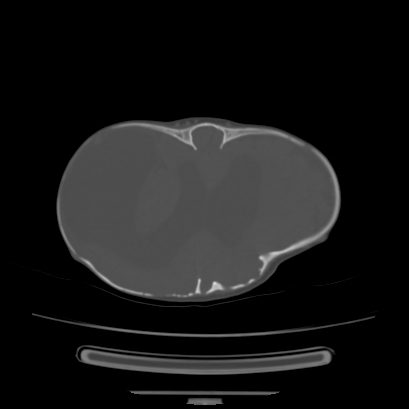 Cloverleaf skull (Radiopaedia 91901-109710 Axial bone window 105).jpg