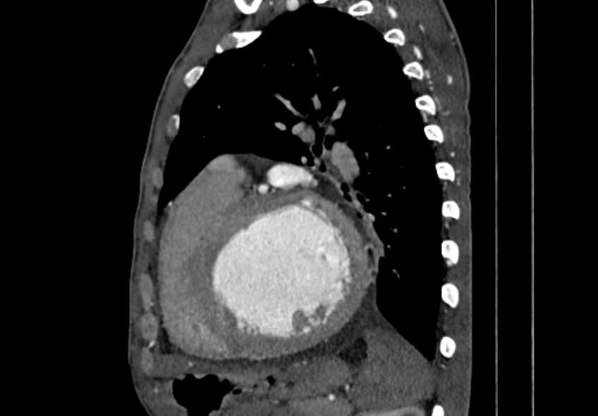 Coarctation of aorta with aortic valve stenosis (Radiopaedia 70463-80574 B 131).jpg