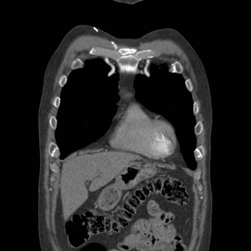 File:Coarctation of the aorta (Radiopaedia 17427-17116 A 70).jpg
