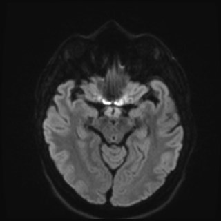 File:Cochlear incomplete partition type III associated with hypothalamic hamartoma (Radiopaedia 88756-105498 Axial DWI 57).jpg