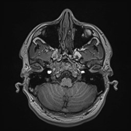 File:Cochlear incomplete partition type III associated with hypothalamic hamartoma (Radiopaedia 88756-105498 Axial T1 50).jpg