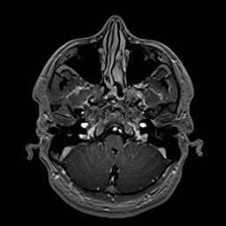 File:Cochlear incomplete partition type III associated with hypothalamic hamartoma (Radiopaedia 88756-105498 Axial T1 C+ 48).jpg