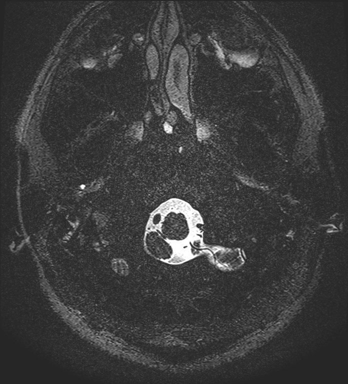 Cochlear incomplete partition type III associated with hypothalamic hamartoma (Radiopaedia 88756-105498 Axial T2 7).jpg