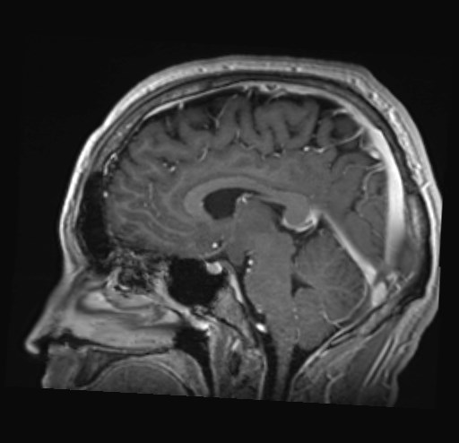 Cochlear incomplete partition type III associated with hypothalamic hamartoma (Radiopaedia 88756-105498 Sagittal T1 C+ 29).jpg