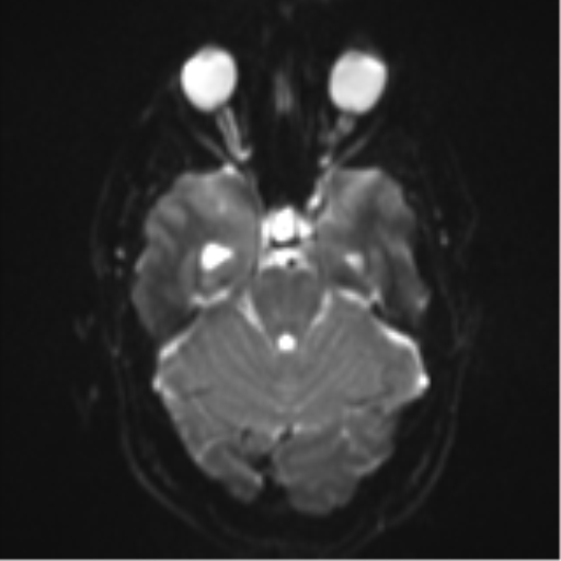 File:Colloid cyst (Radiopaedia 44510-48181 Axial DWI 9).png