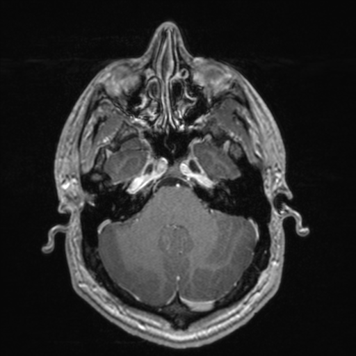 File:Colloid cyst (Radiopaedia 44510-48181 Axial T1 C+ 53).png