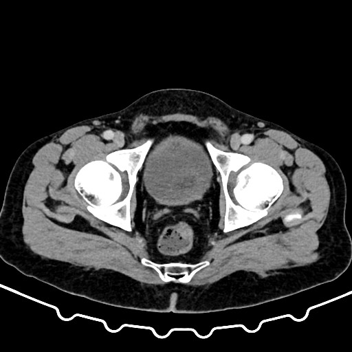 Colocolic intussusception due to large lipoma (Radiopaedia 68773-78482 A 182).jpg