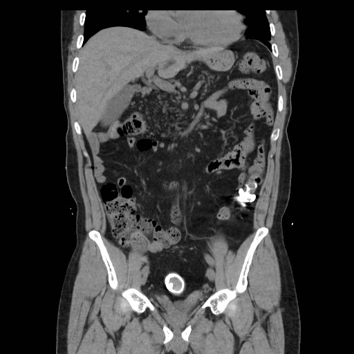 File:Colocutaneous fistula in Crohn's disease (Radiopaedia 29586-30093 E 15).jpg