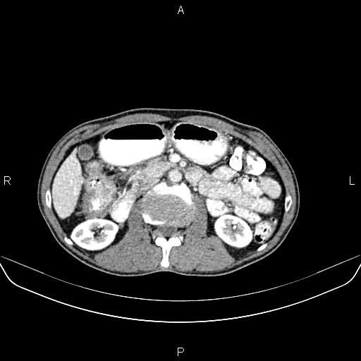 File:Colon adenocarcinoma - hepatic flexure (Radiopaedia 85635-101395 A 38).jpg