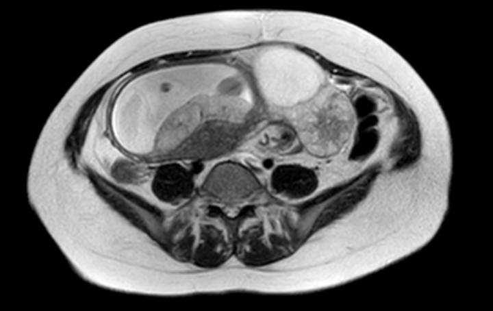 Colon adenocarcinoma with Krukenberg tumors, advanced pregnancy (Radiopaedia 67279-76645 Axial T2 30).jpg