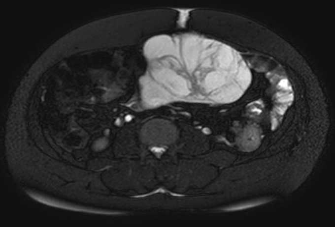 Colon adenocarcinoma with Krukenberg tumors, advanced pregnancy (Radiopaedia 67279-76645 Axial T2 SPAIR 39).jpg
