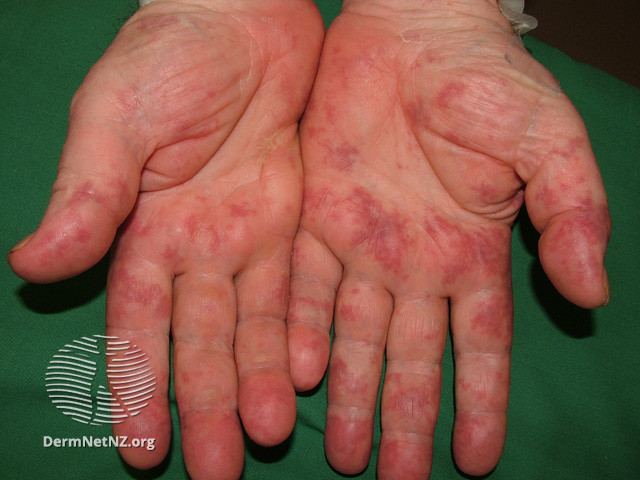 File:Cryoglobulinaemia (DermNet NZ vascular-cryoglob3).jpg