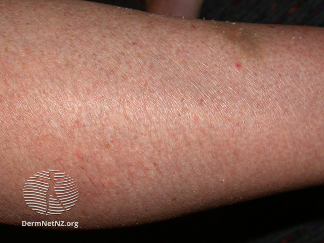 File:Dry skin (DermNet NZ systemic-dry-skin).jpg