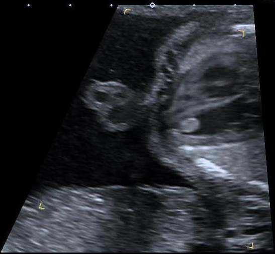 File:Fetal cardiac rhabdomyoma (Radiopaedia 37043).jpg