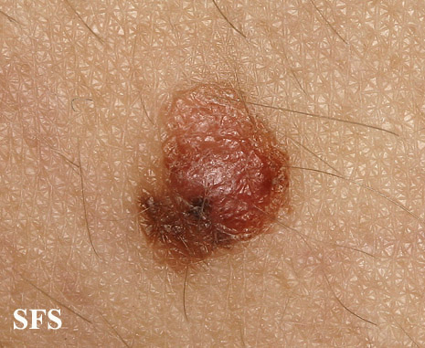 File:Melanoma (Dermatology Atlas 34).jpg