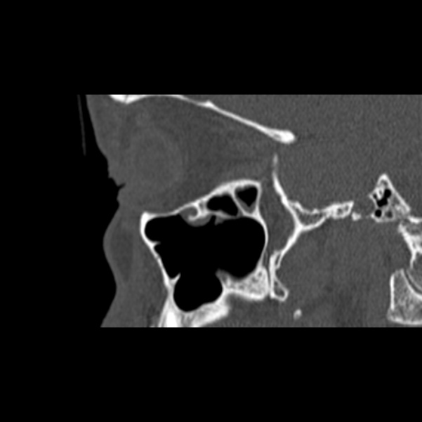 Nasal septal perforation (Radiopaedia 25030-25289 Sagittal bone window 54).jpg