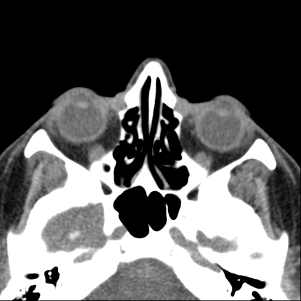 Nasolabial cyst (Radiopaedia 33987-35205 Axial non-contrast 29).jpg