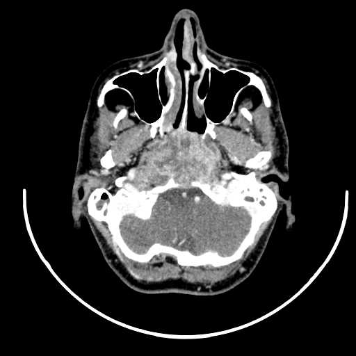 Nasopharyngeal carcinoma - infiltrating the clivus (Radiopaedia 62583-70875 Axial Post contrast 15).jpg