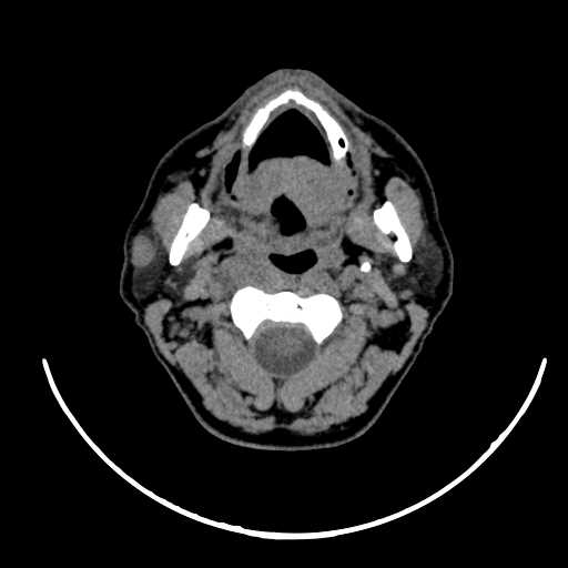File:Nasopharyngeal carcinoma - infiltrating the clivus (Radiopaedia 62583-70875 Axial non-contrast 26).jpg