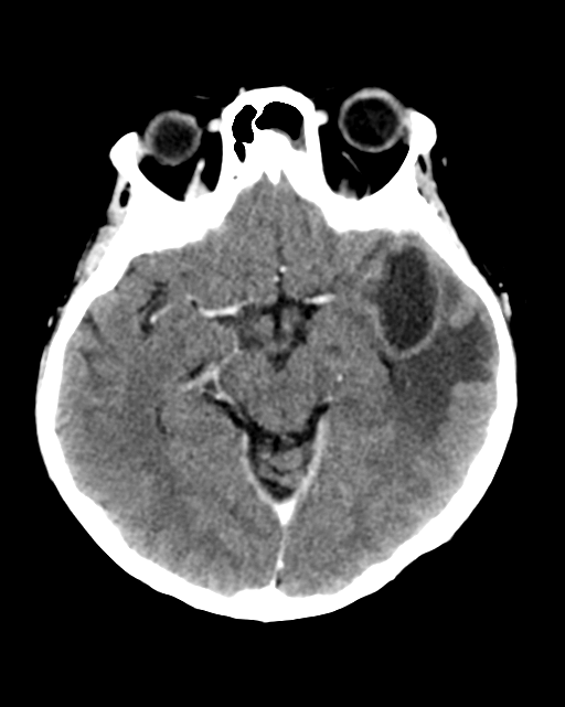 Nasopharyngeal carcinoma with cerebral abscess (Radiopaedia 43018-46275 Axial C+ delayed 22).png