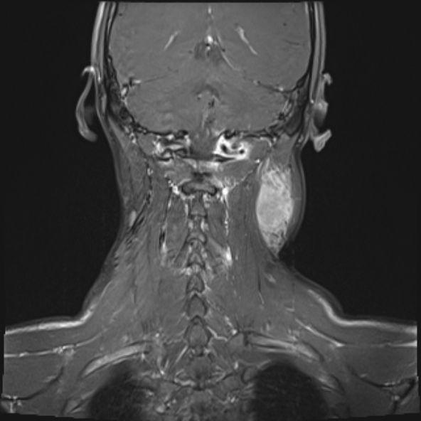 Nasopharyngeal carcinoma with skull base invasion (Radiopaedia 53415-59485 E 5).jpg