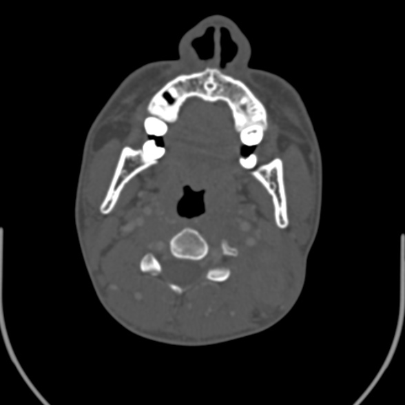 Nasopharyngeal carcinoma with skull base invasion (Radiopaedia 53415-59705 Axial bone window 91).jpg