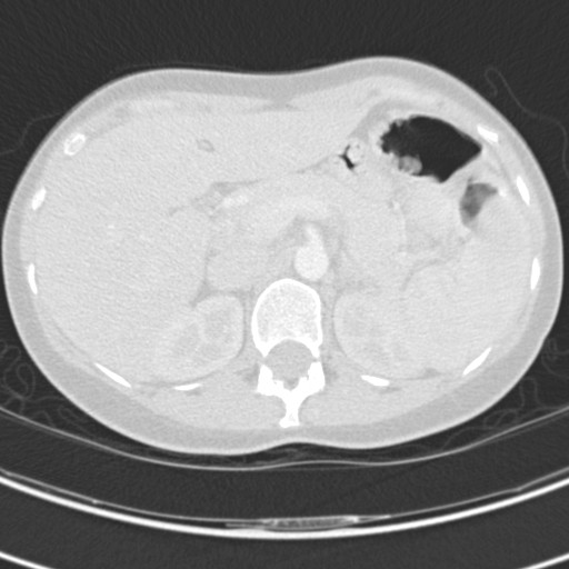 Necrobiotic pulmonary nodules - Crohn disease (Radiopaedia 20723-20631 Axial lung window 145).jpg